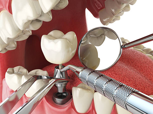Best Emergency Dentist for Knocked-Out Tooth in Huntington, TX